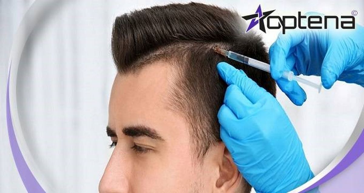 راهنمای انتخاب بهترین دکتر کاشت مو در سال 1401