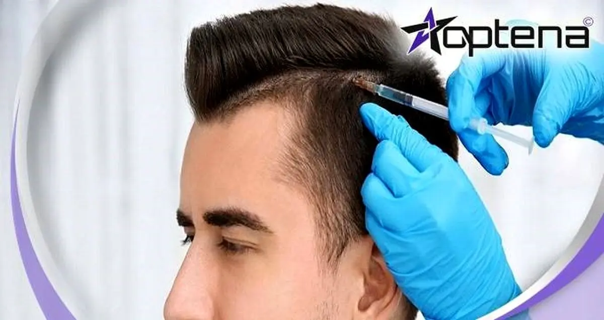 راهنمای انتخاب بهترین دکتر کاشت مو در سال 1401