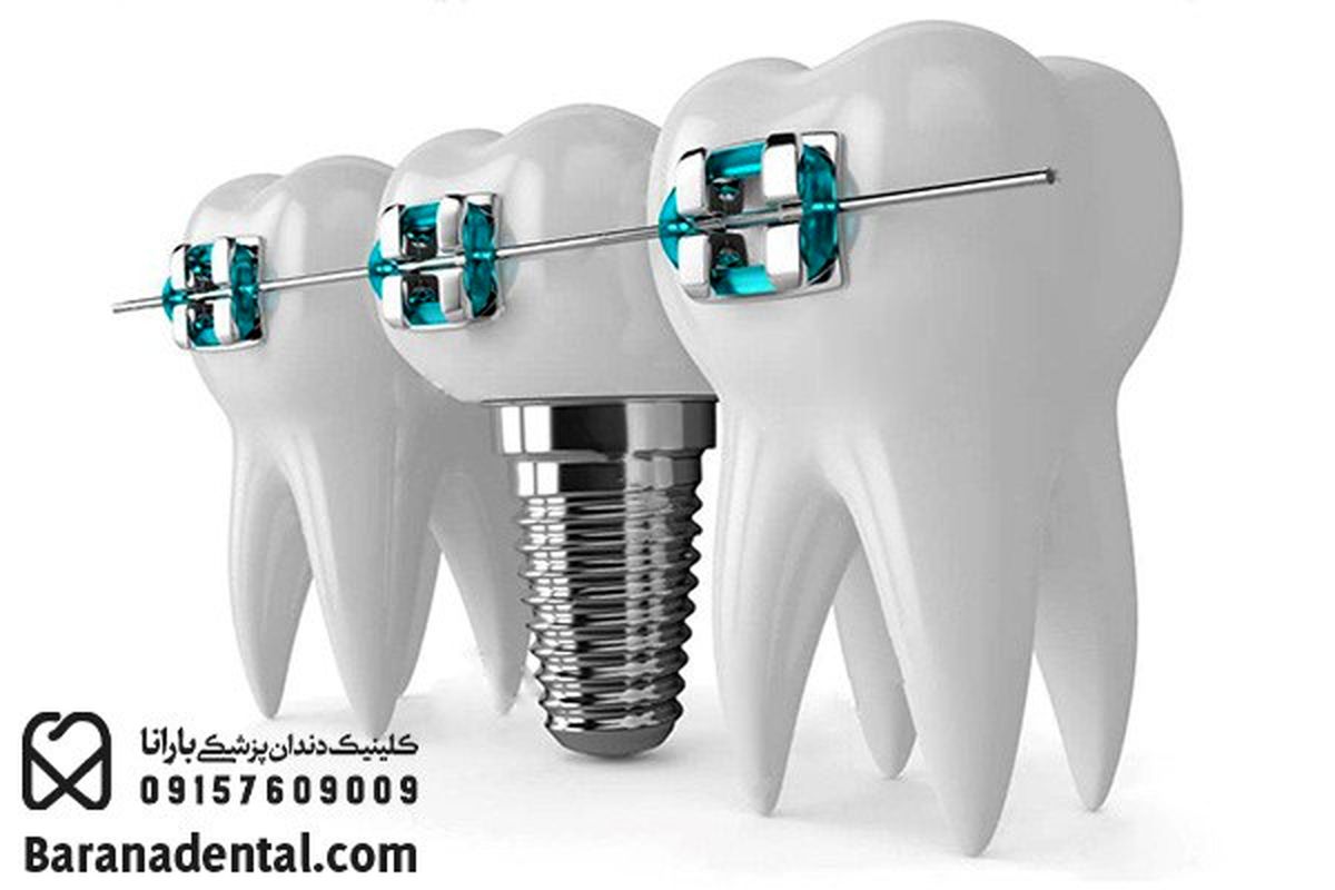 ارتودنسی پیش از کاشت ایمپلنت بهتر است یا بعد آن؟!
