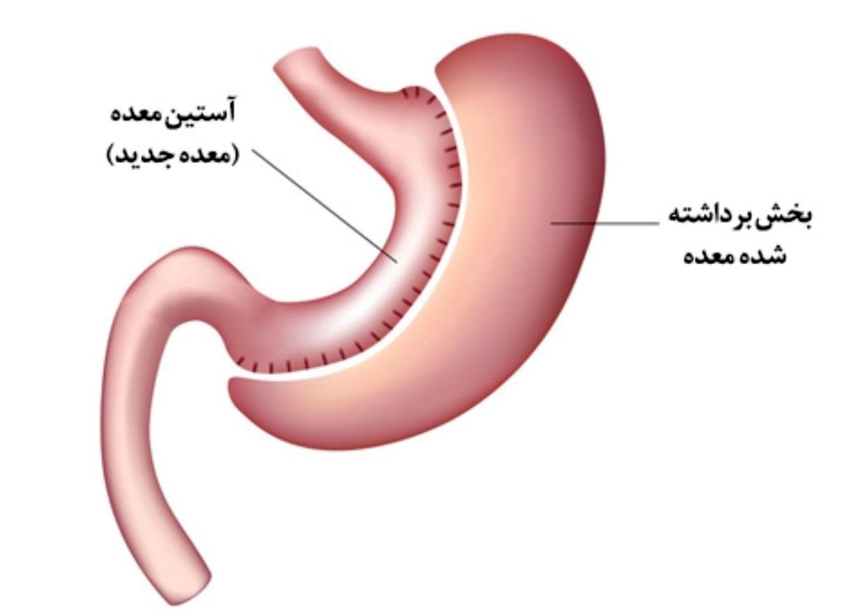 اسلیو معده در بیمارستان خاتم