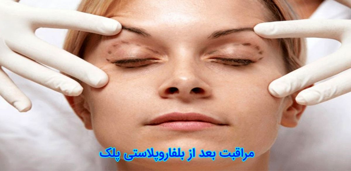 در مورد مراقبت بعد از بلفاروپلاستی پلک بیشتر بدانید