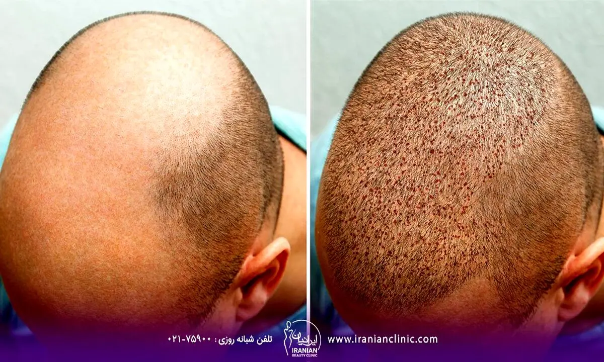 راهنمای کاشت مو برای رفع طاسی سر