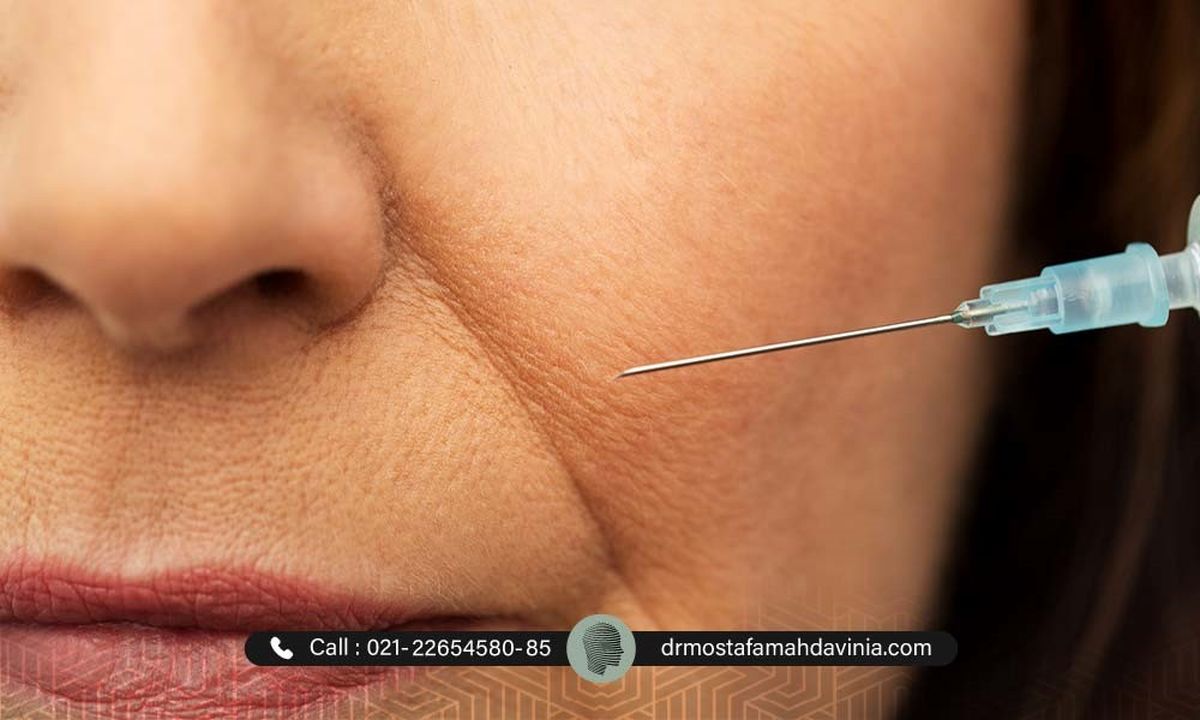 تزریق ژل خط لبخند (خنده): لبخند خود را با اعتماد به نفس تقویت کنید