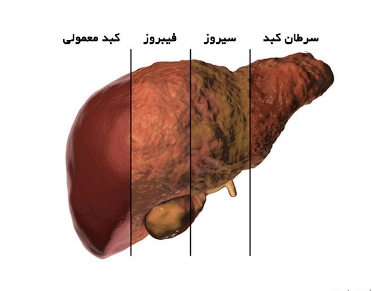 راه هایی که کبد را پاکسازی می کند!