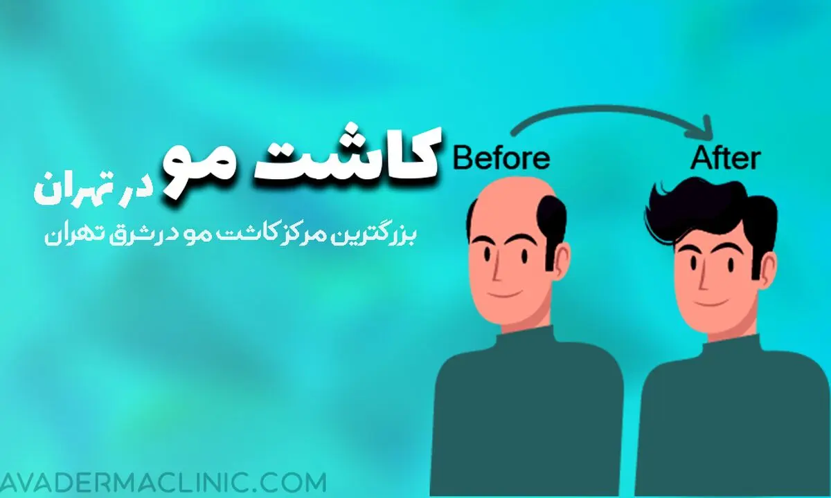 کاشت مو