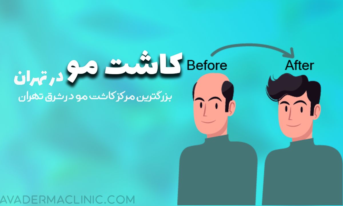 کاشت مو
