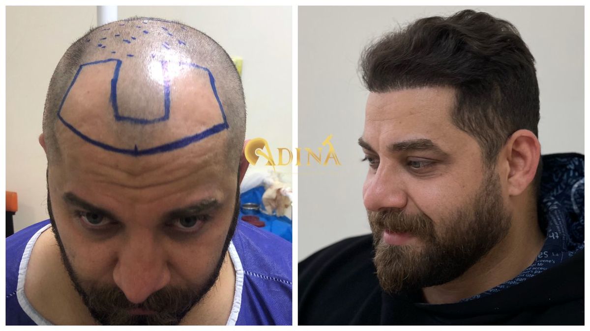 بهترین روش کاشت مو در کلینیک های معتبر آمریکا